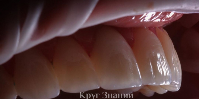 Имплантация зубов под ключ - выгода и удобство в одном
